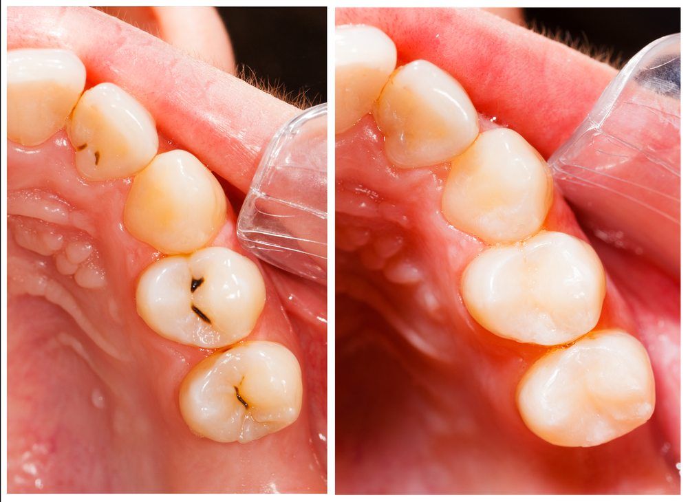 Tooth Coloured Fillings